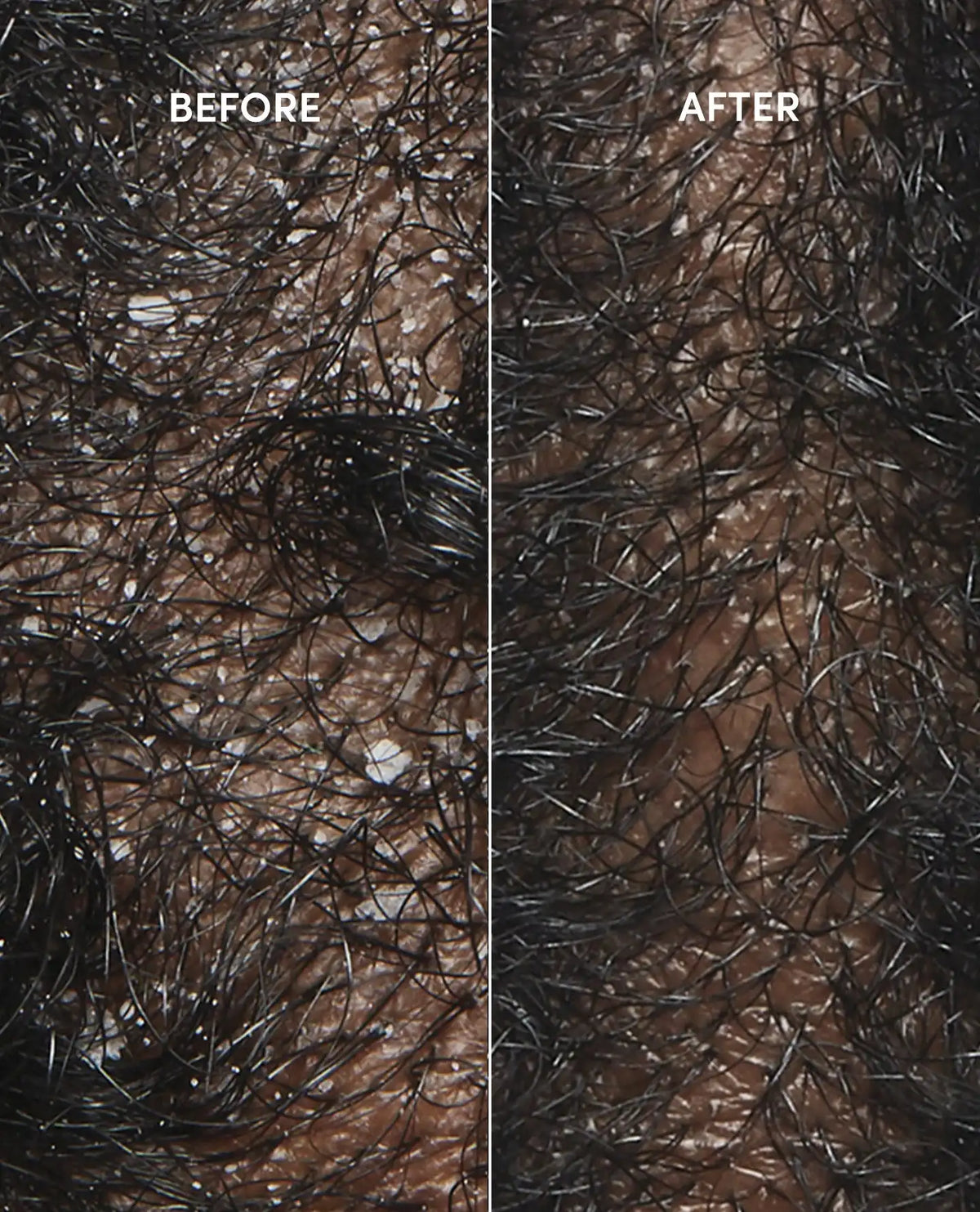 Anti-Dandruff Hair Shampoo